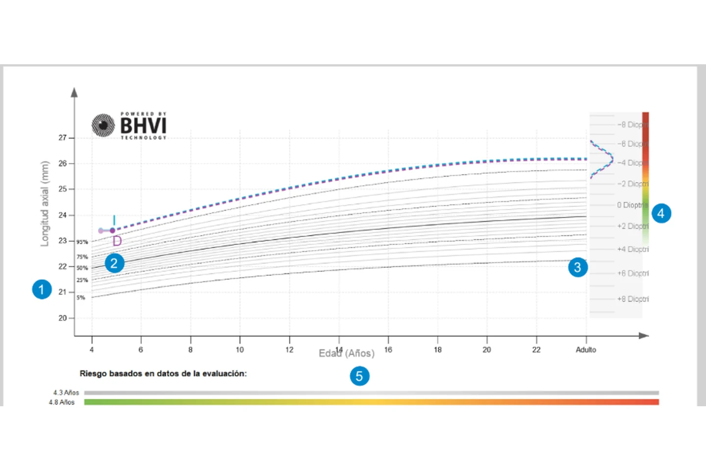 Ejemplo visual de una gráfica de seguimiento de longitud axial con Myopia Master